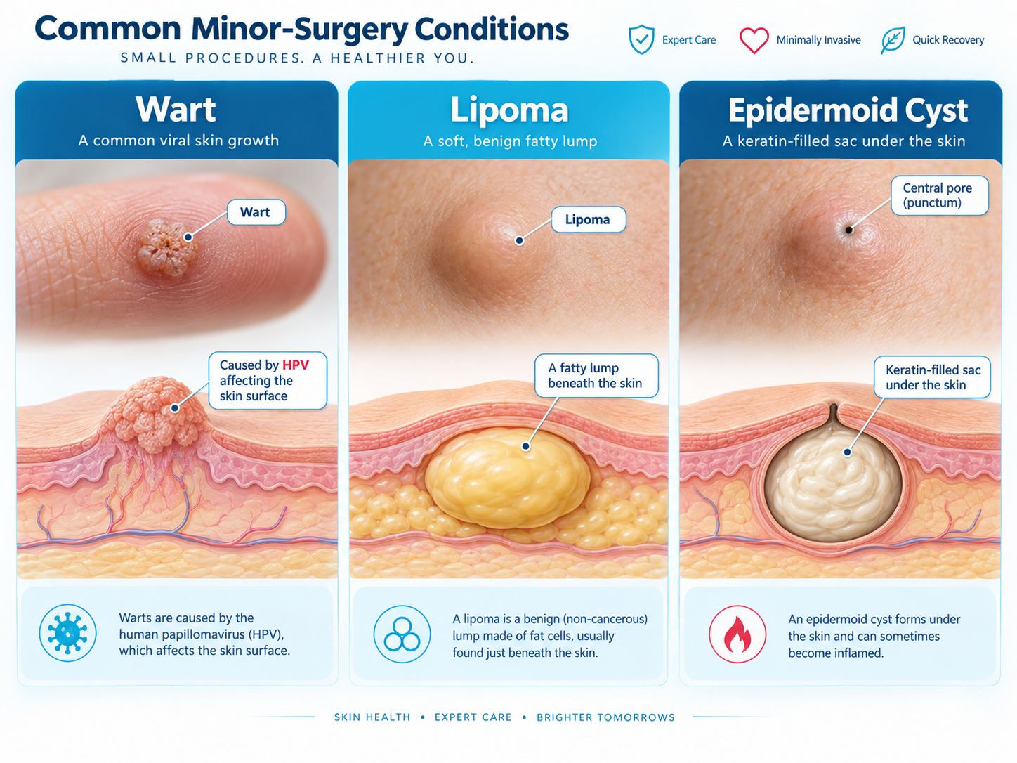 Ilustrasi pendidikan menunjukkan perbezaan wart, lipoma dan cyst pada kulit